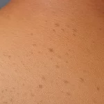 Sırt sivilcesi olanların duş rutini nasıl olmalı