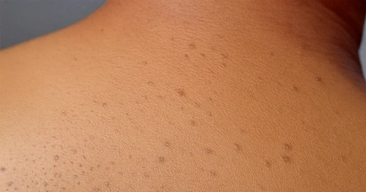 Sırt sivilcesi olanların duş rutini nasıl olmalı